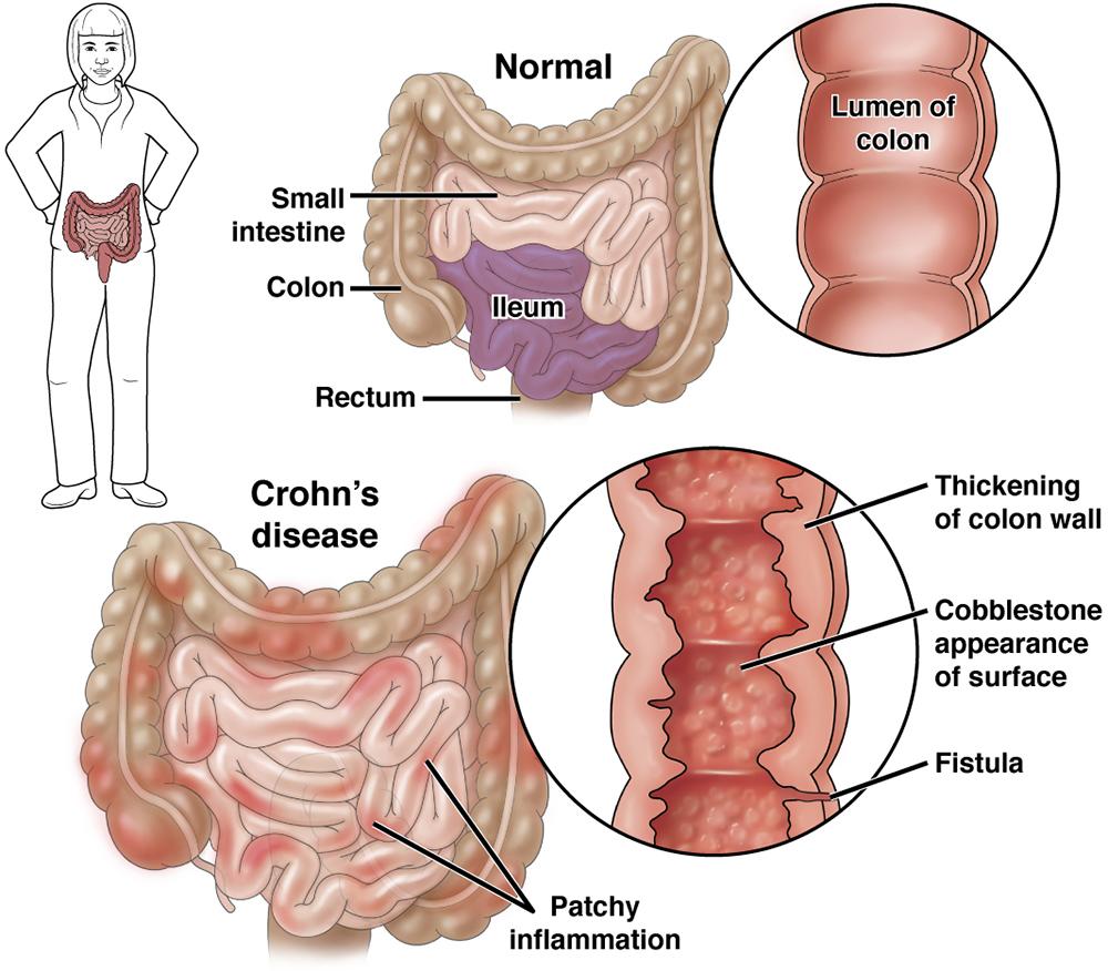 νόσος του Crohn