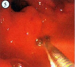 γαστρίτιδα