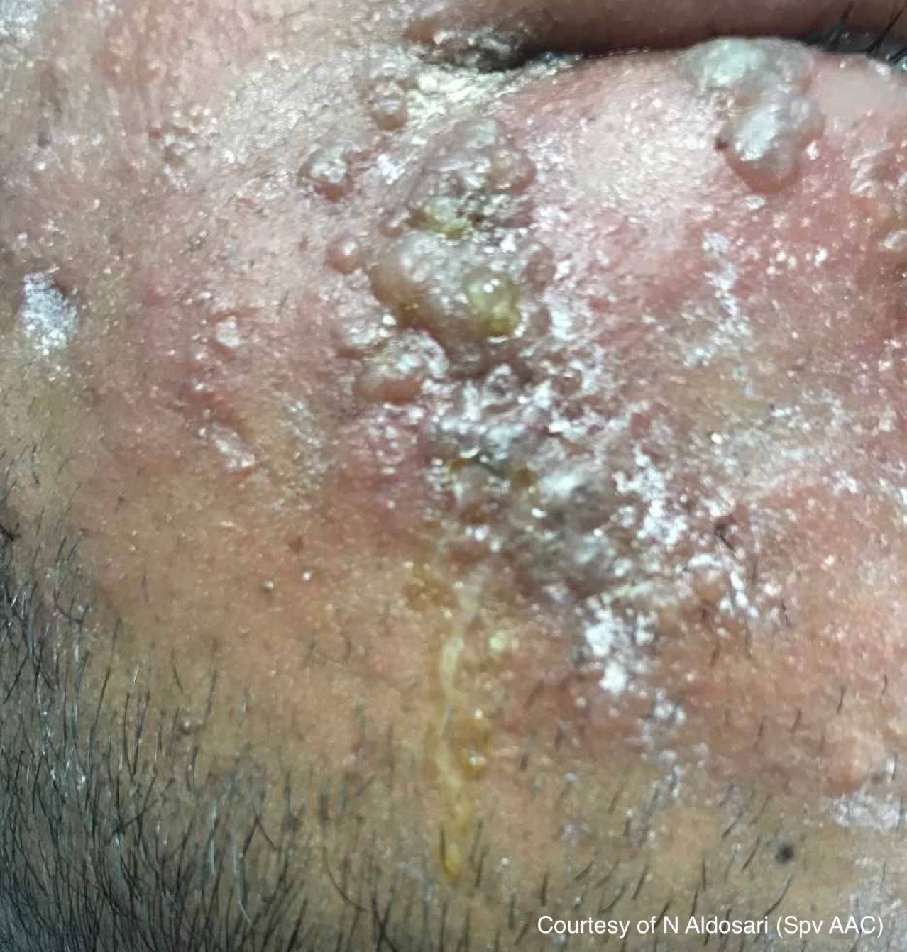 έρπης ζωστήρας